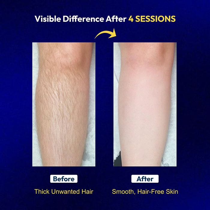 Zaisha Waxing & Zero Regrowth Kit - Permanent Hair Removal